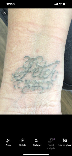 ReNude Laser Tattoo Removal Gold Coast Pic 2 - First treatment with the PicoWave Laser 80 A great result