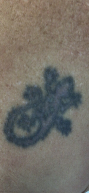 ReNude Laser Tattoo Removal Gold Coast Pic 3 - This poor little gecko have lists its definition so its time to go