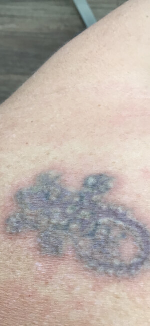 ReNude Laser Tattoo Removal Gold Coast Pic 4 - Fist treatment with the PicoWave Laser 80 and a great start