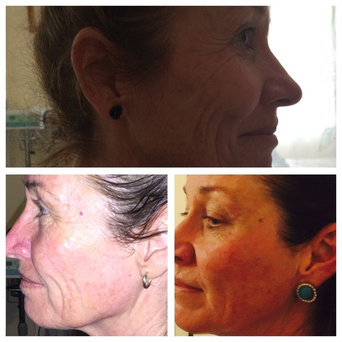 Bernie's Beauty Pic 1 - Facial skin tightening before after