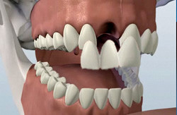 Raceview Dental Surgery Pic 3 - Dental Bridge Ipswich