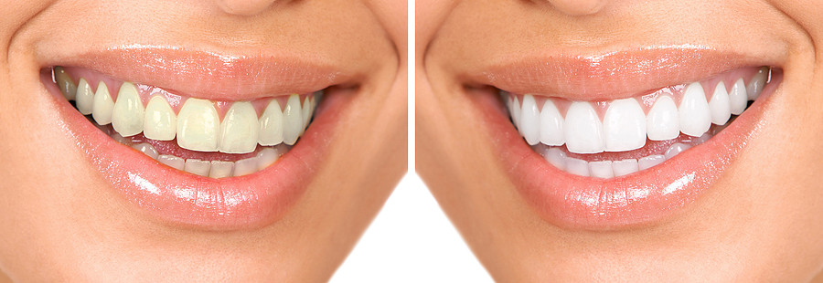 Raceview Dental Surgery Pic 1 - Ipswich Tooth Whitening Before and After