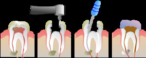 Raceview Dental Surgery Pic 5 - Root Canal Treatment Ipswich