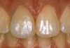 Malcolm Deall & Associates Pic 2 - after porcelain crowns