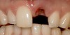 Malcolm Deall & Associates Pic 5 - before dental implants