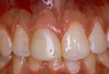 Malcolm Deall & Associates Pic 1 - before porcelain crowns