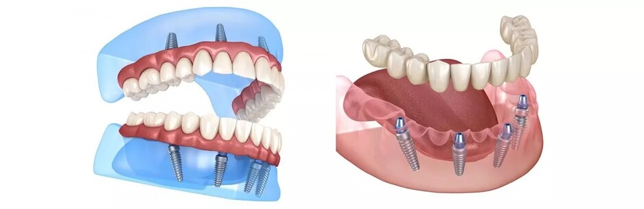 All on 4 Dental Implants Melbourne Pic 1