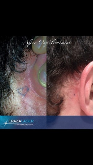 Eraza Laser Clinic Pic 2