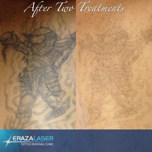 Eraza Laser Clinic Pic 4