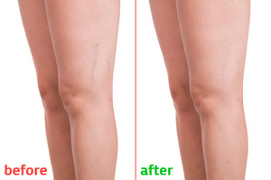 Vein Solutions Pic 2 - Beforeandafterveintreatment