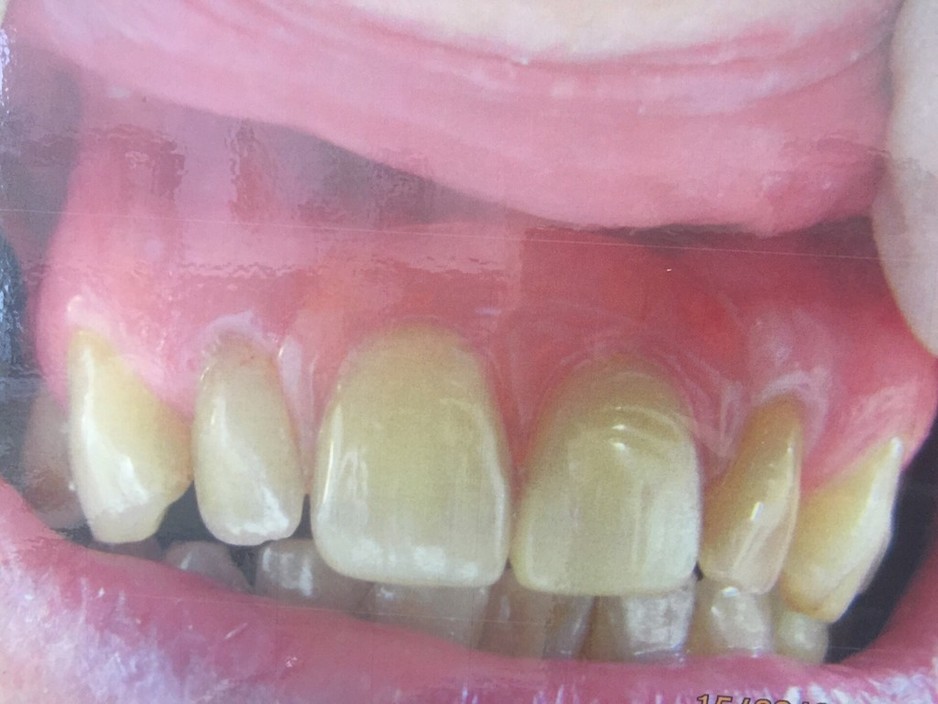 Cheltenham Denture Clinic Pic 1 - Front two teeth