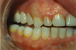 Denture Creations Pic 2 - Small partial denture without metal clasping