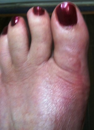 OnePointHealth Pic 4 - Patient B After bunion surgery 3 months