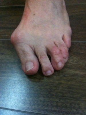 OnePointHealth Pic 3 - Patient B Before Bunion Surgery