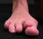 OnePointHealth Pic 5 - Patient C Before bunion and hammertoe surgery