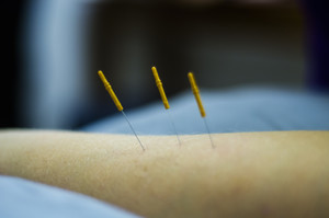 Port Douglas Physiotherapy Pic 4 - Dry Needling