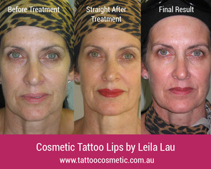 Cosmetic Tattoo Clinic Pic 2 - Lip Tattoos Sunshine Coast