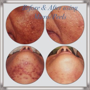 Lavender Lane Beauty Pic 5 - Results shown from MicrodermPeels