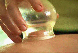 House Of Qi Pic 5 - Cupping