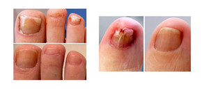 Lakeside Podiatry Pic 3 - Before and after nail laser