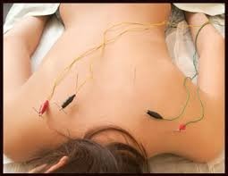 Maleny Acupuncture Pic 4 - Electro Acupuncture