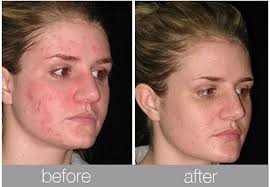 Organic Simplicity Pic 3 - Acne and scaring treatments available