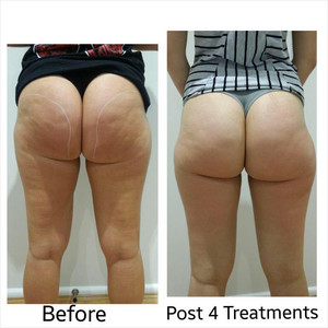 Melbourne Cellulite Treatment Pic 3