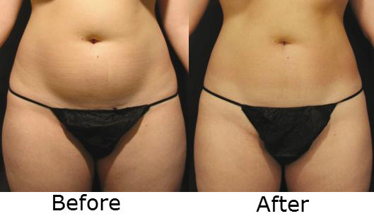 Melbourne Cellulite Treatment Pic 1