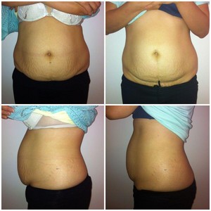 Lissage Body Contouring Pic 3