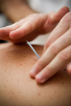 Koten Classical Acupuncture & Moxibustion Pic 2 - Contact Needle Koten Acupuncture Gold Coast