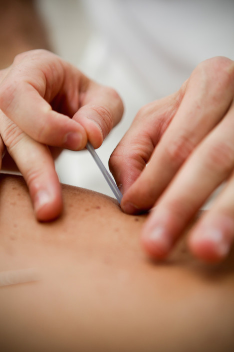 Koten Classical Acupuncture & Moxibustion Pic 1 - Contact needle Koten Acupuncture Gold Coast