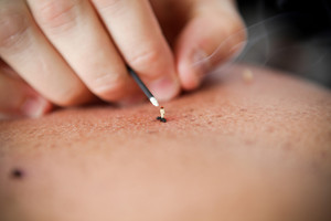 Koten Classical Acupuncture & Moxibustion Pic 4 - Rice Grain Moxibustion Koten Acupuncture Gold Coast