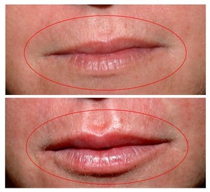 Cosmetic Elegance Clinic Pic 4 - Dermal fillers