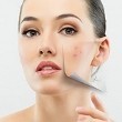 Facial Rejuvenation - YoungerYouClinic Pic 1 - Improve acne and chicken pox scars and surgical scars