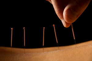 Sunshine Central Medical Clinic Pic 2 - We provide Acupuncture with Medicare Rebates