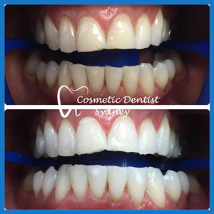 Cosmetic Dentist Sydney Pic 3 - Teeth Whitening