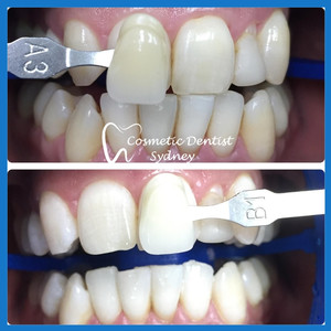 Cosmetic Dentist Sydney Pic 4 - Teeth Whitening