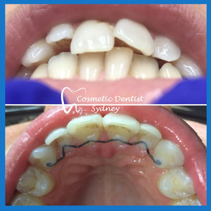 Cosmetic Dentist Sydney Pic 5 - Orthodontics