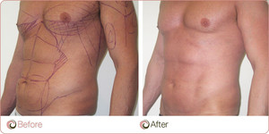 Cosmos Clinic Pic 2 - Vaser Hi Definition Liposuction