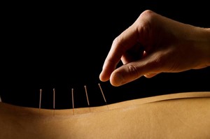 Freedom Physiotherapy a personal approach Pic 2 - dry needling one of the many services we offer