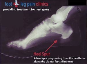 Foot + Leg Pain Clinics Pic 4 - Heel Spur Treatments