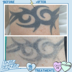 Lazer Erazer Tattoo Removal Pic 5