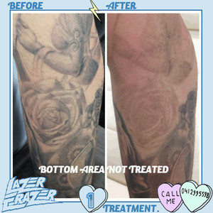 Lazer Erazer Tattoo Removal Pic 4