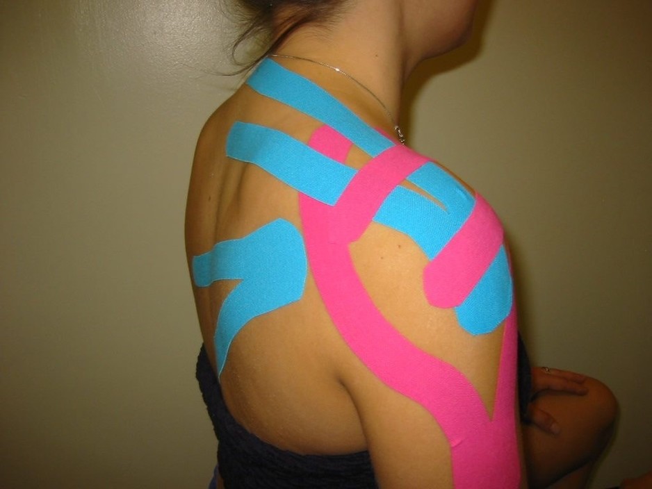 Remedial Action Pic 1 - Kinesio Taping