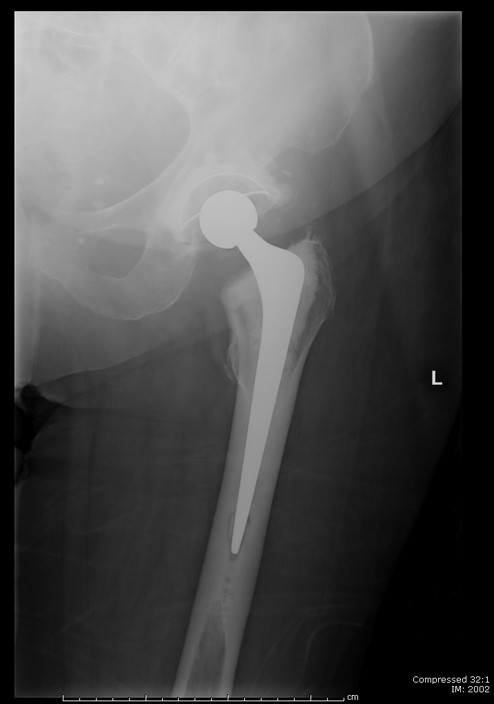 Dirk van Bavel Orthopaedic Surgeon Pic 1 - Cemented hip replacement