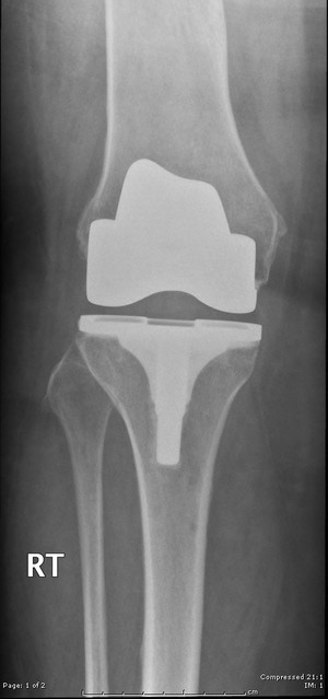 Dirk van Bavel Orthopaedic Surgeon Pic 3 - Knee replacement