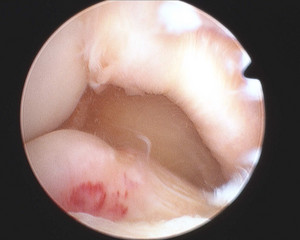 Dirk van Bavel Orthopaedic Surgeon Pic 5 - MPFL reconstruction for patella instability