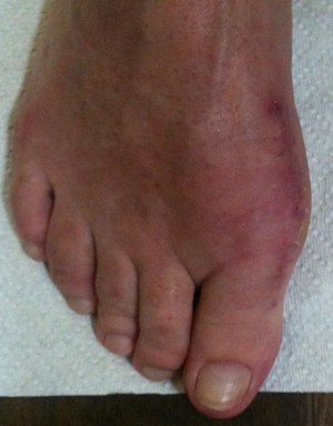 Podiatric Surgery Centre Pic 3 - Patient A 3 weeks post bunion surgery Day surgery with immediate weight bearing