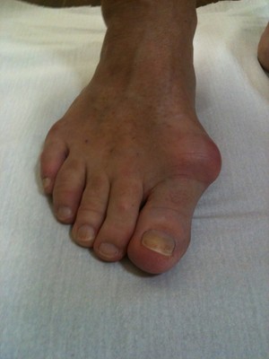 Podiatric Surgery Centre Pic 2 - Patient A Presented with painful bunions both feet Clinical assessment and xrays indicated osteoarthritis within the joint