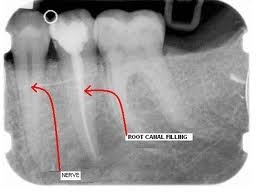 laserrootcanal Pic 2